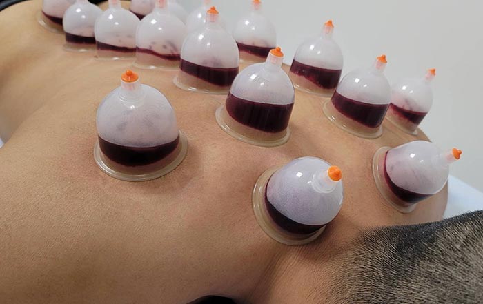 hijama back