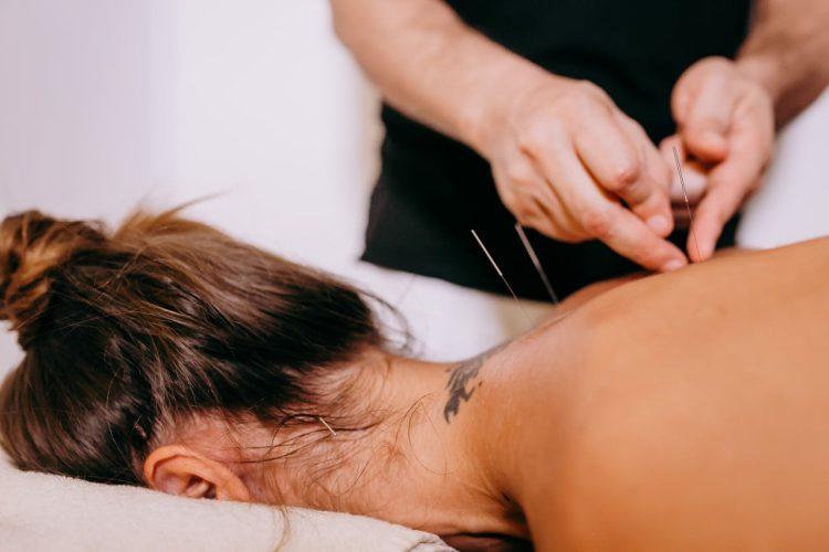 top acupuncture benefits